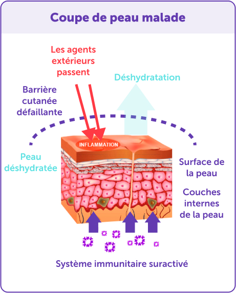 Peau atteinte de dermatite atopique