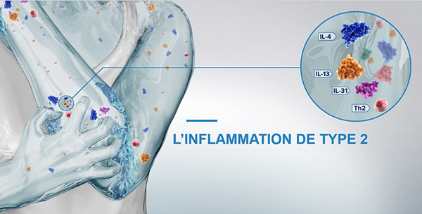 L’inflammation de type 2
