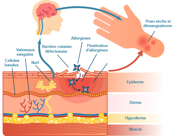Illustration anomalie de la barrière cutanée